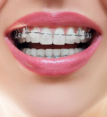 ΟΡΘΟΔΟΝΤΙΚΗ