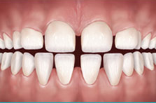 μεγάλα κενά δοντιών