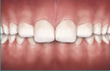 συνωστισμός δοντιών