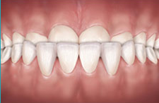 συνωστισμός δοντιών