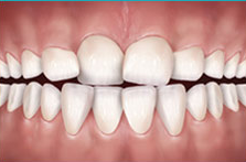 συνωστισμός δοντιών